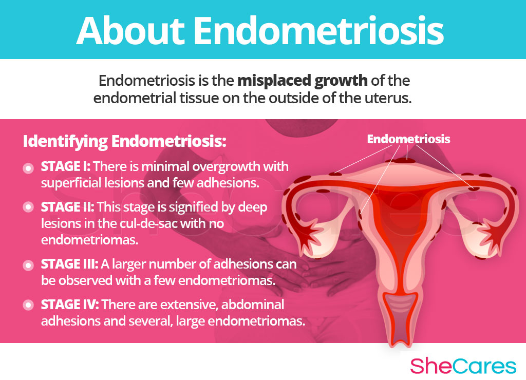 Endometriozis: Belirtileri ve Tedavisi